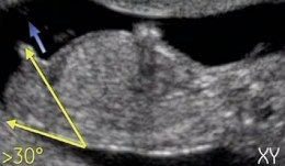Какой ребенок в 12 недель беременности: фото пол ребенка