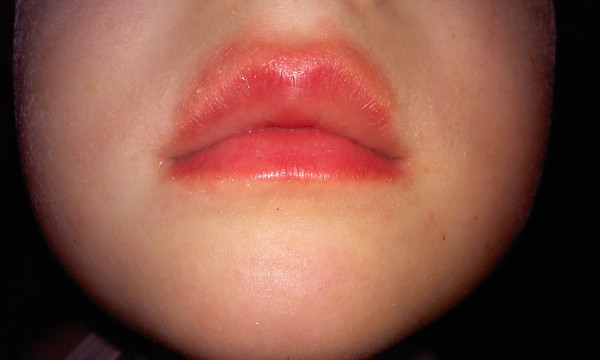 Причины и лечение обветренных губ