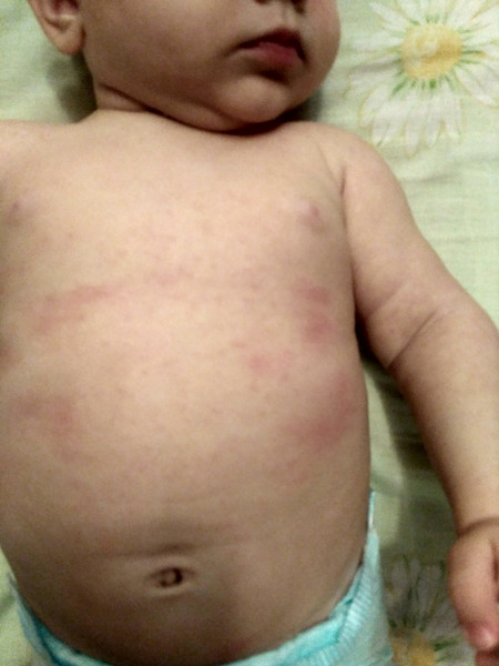 Розеола: сыпь у ребенка после температуры