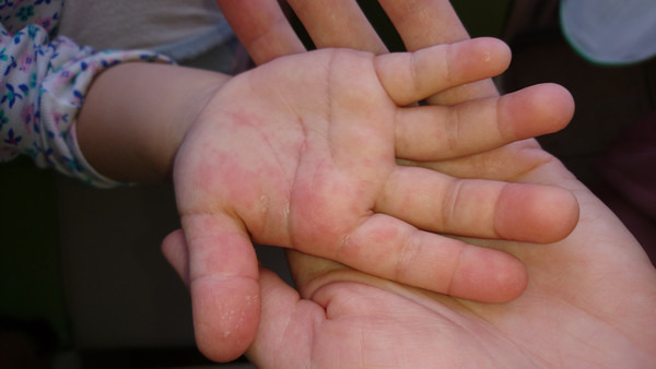 Сухая кожа рук: каких витаминов не хватает при шелушении кожи