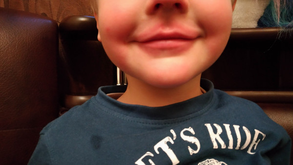 Обветривание губ у ребенка: как избежать неприятностей? | Юнилайн