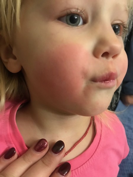 Ребенку год красные щеки. Красные щеки у ребенка 3 года. Красные щеки у ребенка 5 лет.