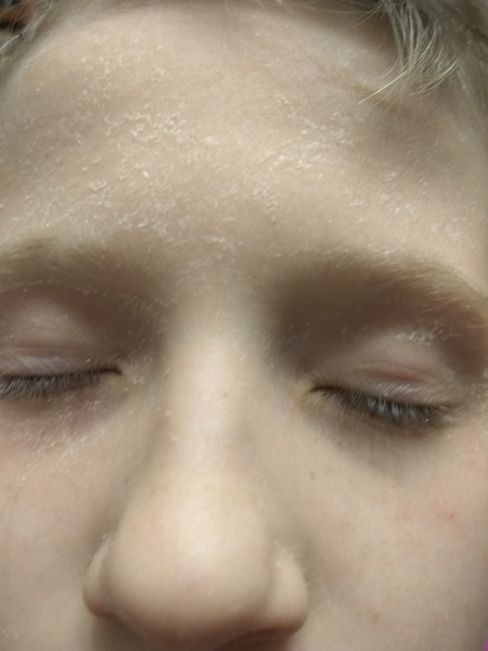 Почему возникает шелушение на лице и сильно шелушится кожа