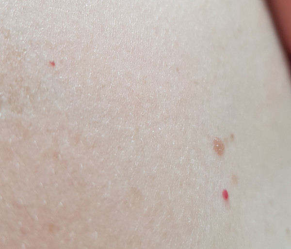 Маленькие красные точки на теле – что означают и как избавиться от пятнышек-ангиом