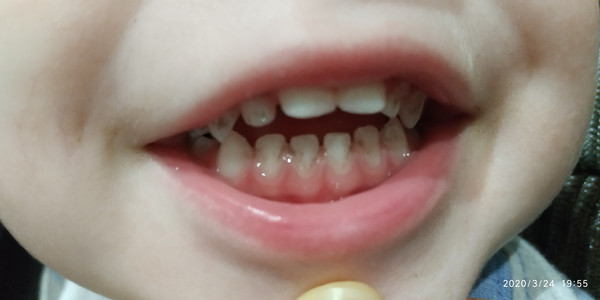 Налет на зубах у детей. Виды и причины появления